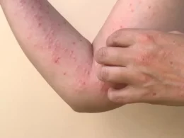 monkeypox