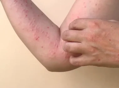 monkeypox