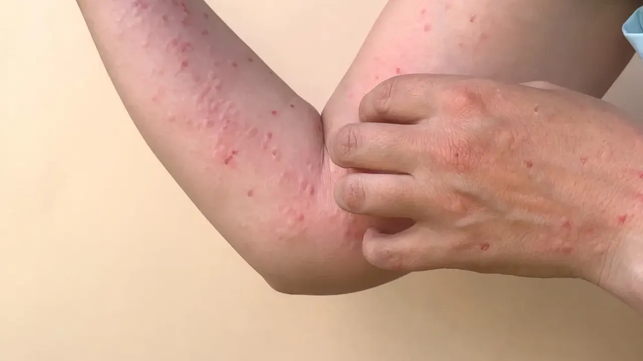 monkeypox