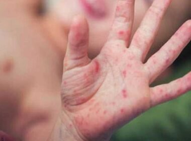 Measles Outbreak sindh