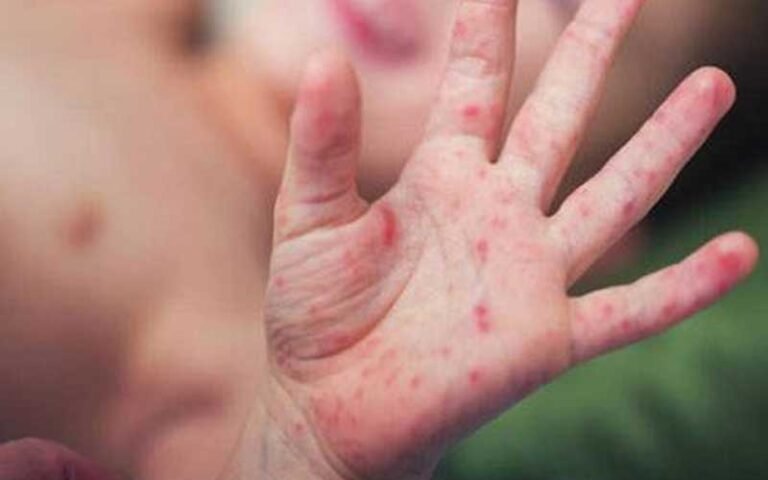 Measles Outbreak sindh