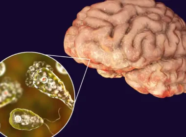 Naegleria fowleri death Karachi