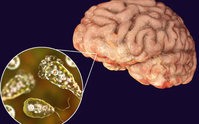 Naegleria fowleri death Karachi