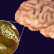 Karachi Naegleria case