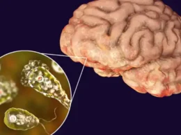 Karachi Naegleria case