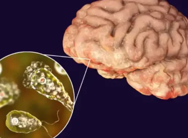 Karachi Naegleria case