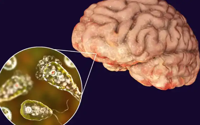 Karachi Naegleria case