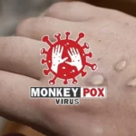 Karachi monkeypox case