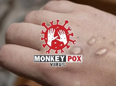 Karachi monkeypox case
