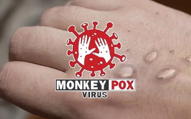 Karachi monkeypox case