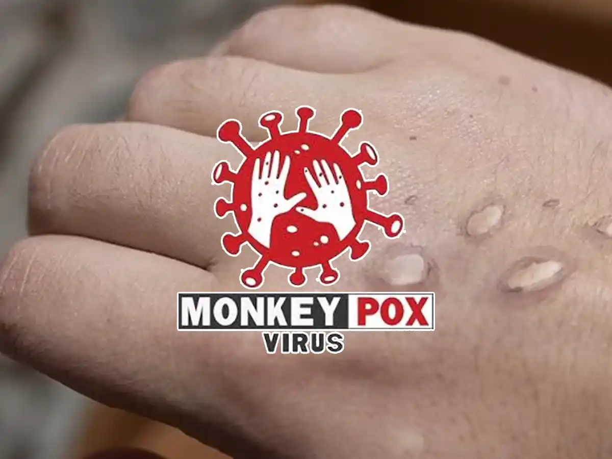 Karachi monkeypox case